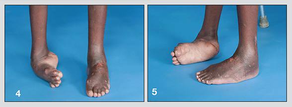 Corrección del pie izquierdo del paciente