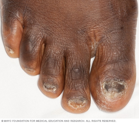 Figure 7 from Nail lichen planus in children: clinical features, response  to treatment, and long-term follow-up. | Semantic Scholar