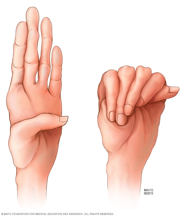 Marfan syndrome hallmarks: claw-shaped hand with long fingers (a