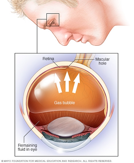 retina detachment surgery gas airplanes blindness
