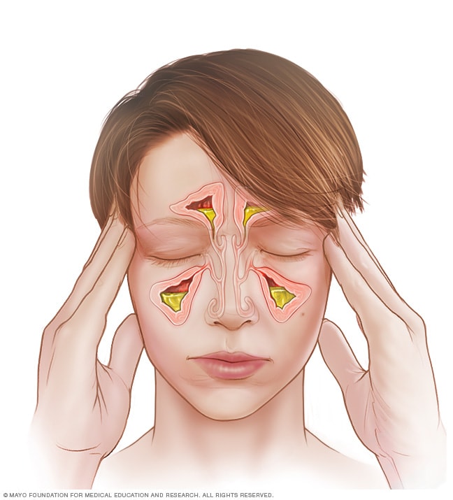 nasal sinus infection symptoms