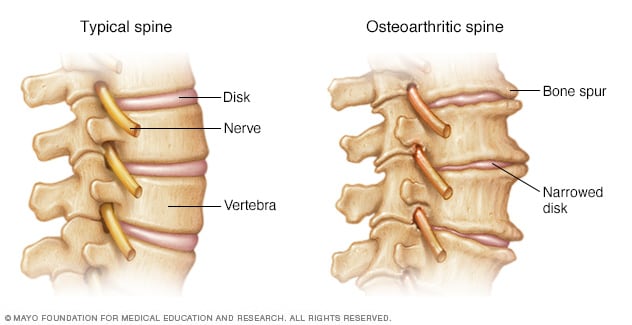 Osteoarthritis of the spine - Mayo Clinic