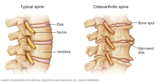 Espolones óseos en la columna vertebral