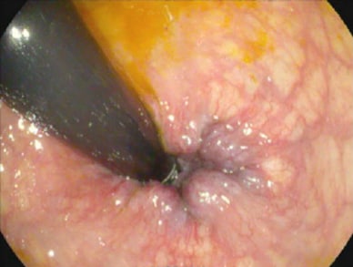 Retroflexed view of internal hemorrhoids on colonoscopy