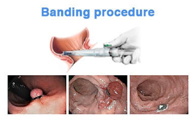 Banding device inserted into distal rectum, then evolution of banded tissue over time