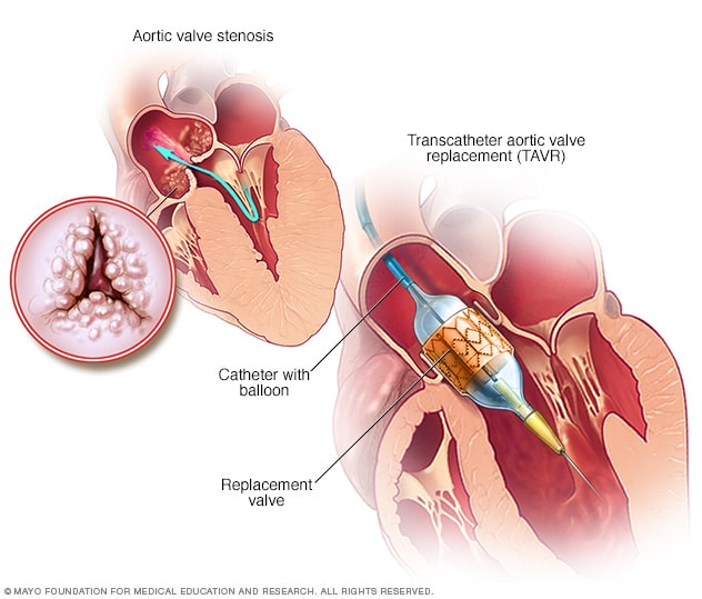 cardiac valve replacement
