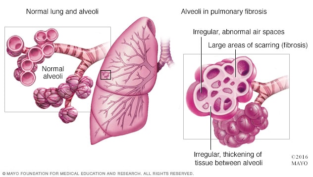 Pulmonary fibrosis - Symptoms and causes - Mayo Clinic diagram of lung sections 