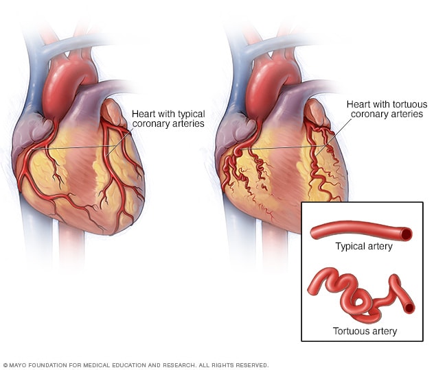 Spontaneous Coronary Artery Dissection SCAD Diagnosis And Treatment Mayo Clinic