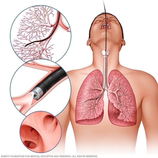 bronchoscopy-mayo-clinic