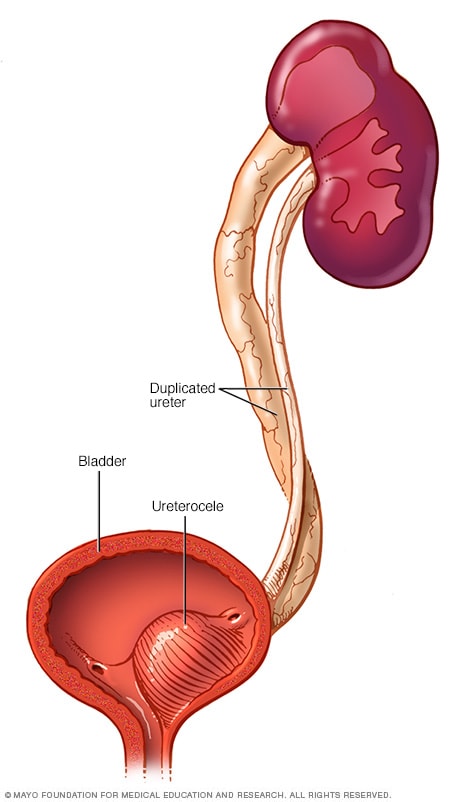 Ureteral obstruction - Symptoms and causes - Mayo Clinic