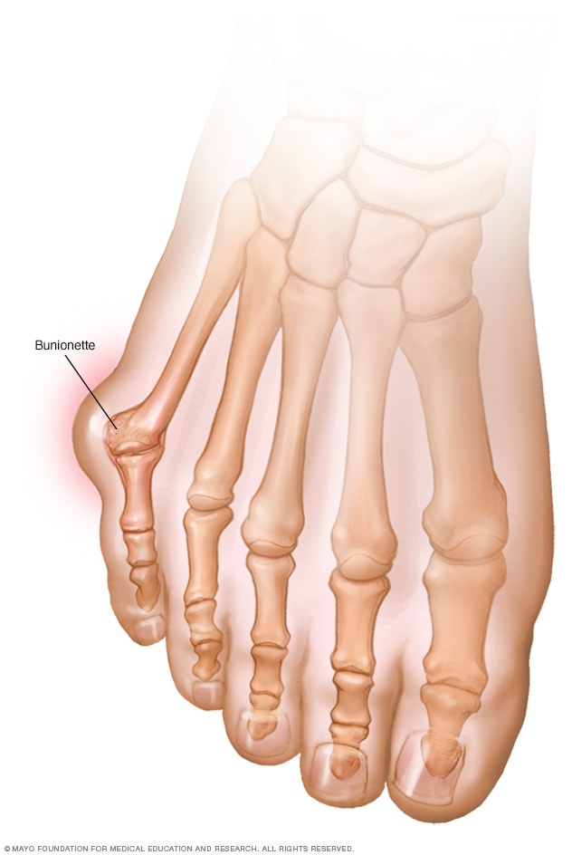 bone growth on foot