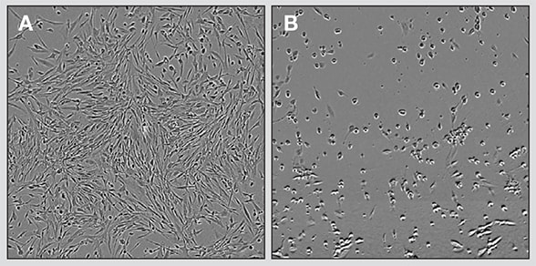 Finding new treatments for high-grade pediatric brain tumors - For