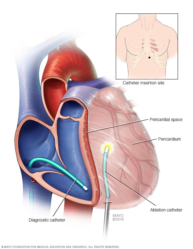 left ventricle ablation flutter