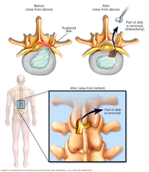 Herniated disk - Diagnosis and treatment - Mayo Clinic