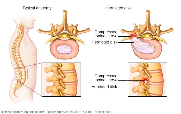 herniated disk nerve pinched surgery sciatica spine symptoms mayo causes due need spinal nucleus clinic vertebrae