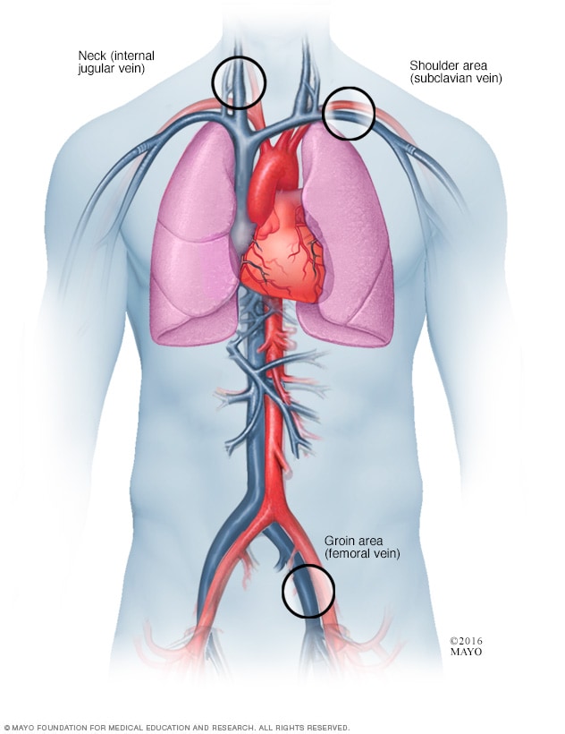 catheter-insertion-points-for-cardiac-ablation-mayo-clinic