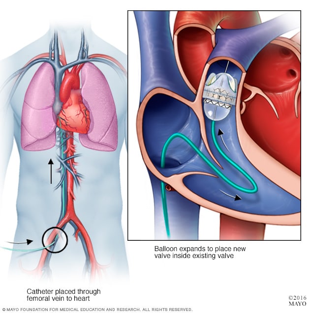 valve check 8 in valve   Mayo Clinic valve Pulmonary replacement