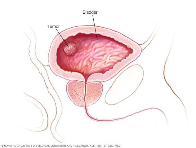 bladder cancer tumor