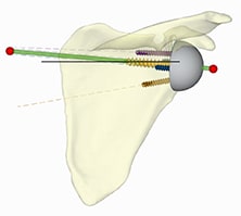 Surgical planning for PSI