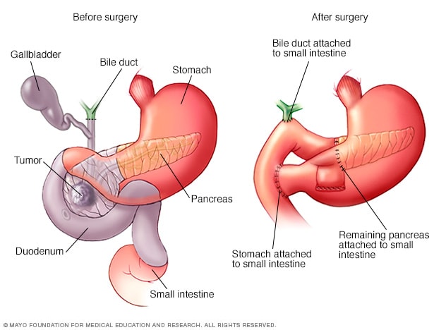 Pancreatic surgery