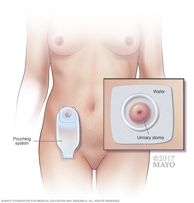 Urinary stoma and pouching system