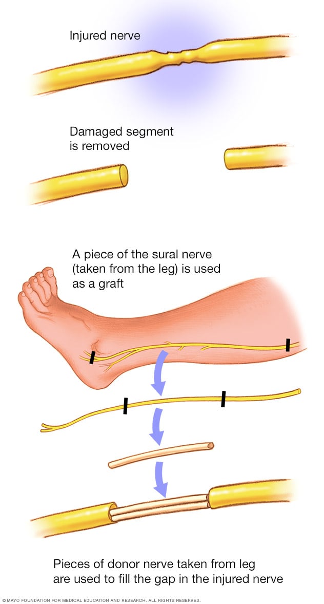 Can peripheral nerves be repaired?