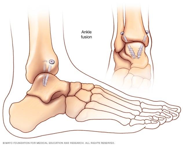 Video On Ankle Joint Replacement