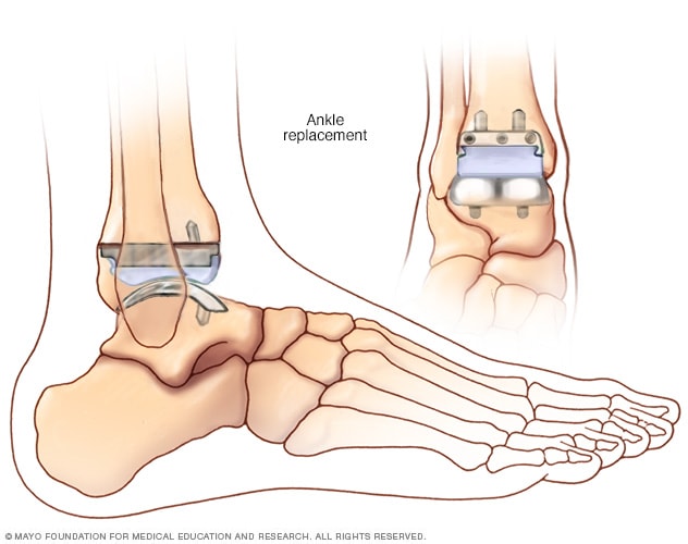 Ankle Surgery Mayo Clinic