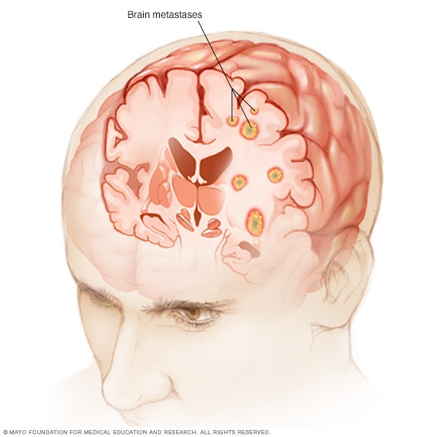 citas con tumor cerebral sintomas fase terminal