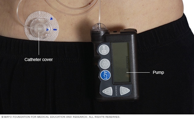 Working of an insulin pump  Download Scientific Diagram