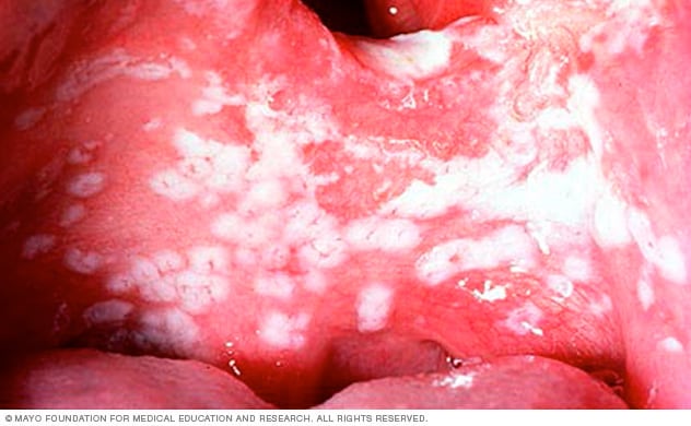 yeast infection in throat