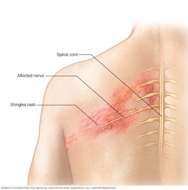 Shingles Symptoms And Causes Mayo Clinic