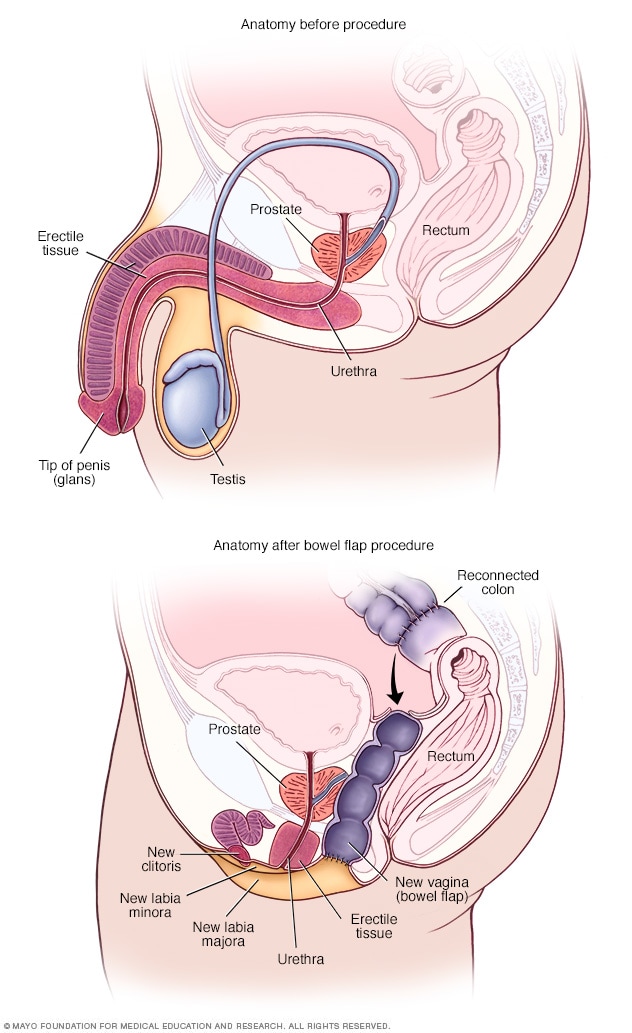 Anatomía antes y después del procedimiento con colgajo de intestino