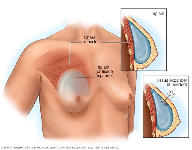 乳房植入物或组织扩张器所在位置