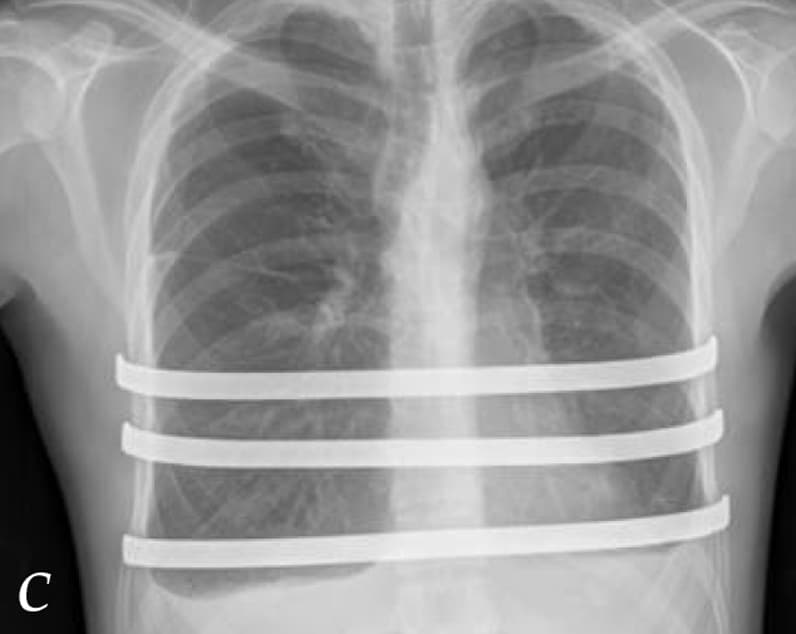 Radiografía de tórax después de colocar tres barras de apoyo