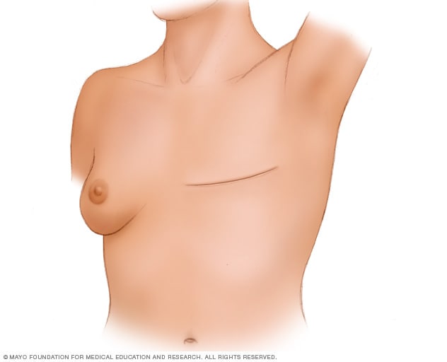 Una persona que se ha sometido a una mastectomía total (simple) sin reconstrucción mamaria