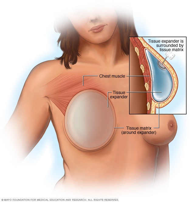 Breast reconstruction with implants - Mayo Clinic