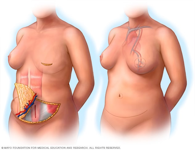 Reconstrucción mamaria mediante cirugía con colgajos - Mayo Clinic