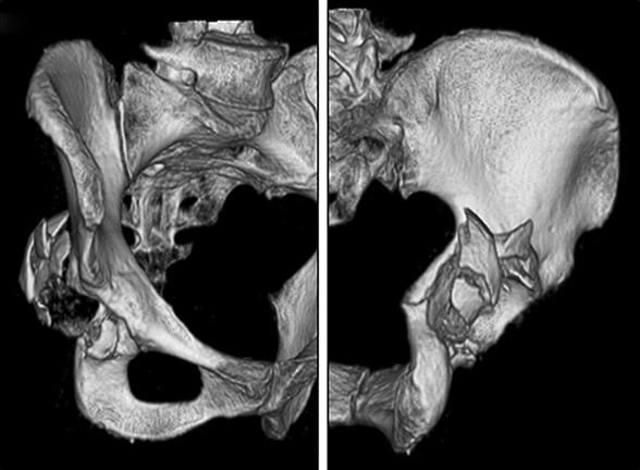 Tomografías computarizadas con reconstrucción tridimensional preoperatorias que muestran la lesión acetabular