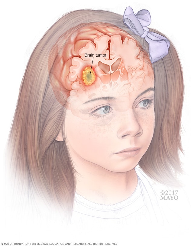 sintomas de cancer en el cerebro