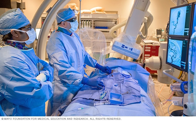Cirujanos de Mayo Clinic llevando a cabo un procedimiento endovascular por un aneurisma cerebral.