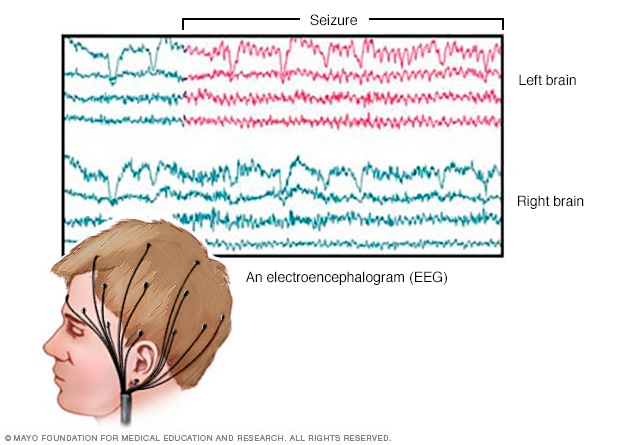 absence seizure vs generalized tonic clonic eeg