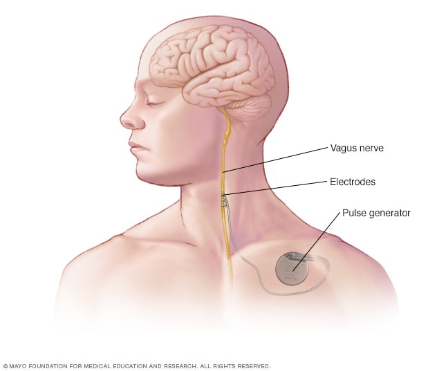 Vagus Nerve Stimulation Device