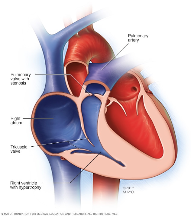 Pulmonary Stenosis Mayo Clinic 5136