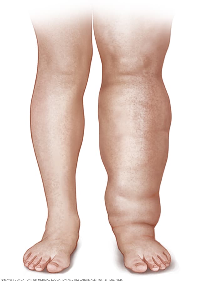 Varicose veins - Symptoms and causes - Mayo Clinic