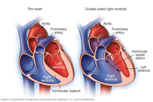Un corazón típico y un corazón con doble salida del ventrículo derecho