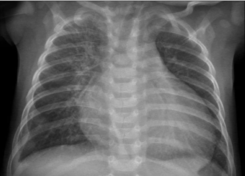 pediatric-cardiogenic-shock-what-is-the-role-of-medical-and-mechanical