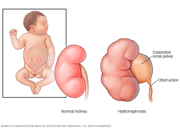 婴儿的正常肾脏和伴有肾积水的肾脏
