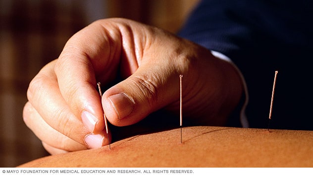 Acupuncture Mayo Clinic - 