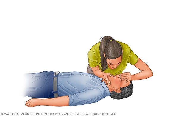 Figure: Doing Chest Compressions in an Adult - MSD Manual Consumer Version